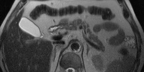 MRI of Pancreatitis and Its Complications: Part 1, Acute Pancreatitis | AJR