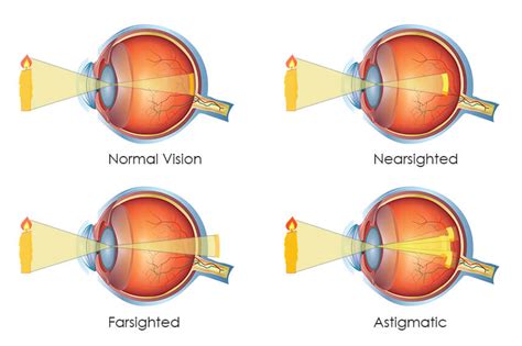 how do glasses work for long sightedness - Amenable Blogger Gallery Of ...