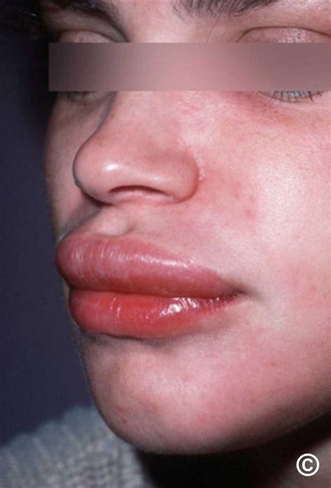 Urticaria and angioedema