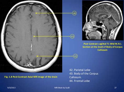 MRI Procedure of Brain