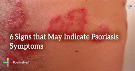 6 Signs that May Indicate Psoriasis Symptoms - PositiveMed