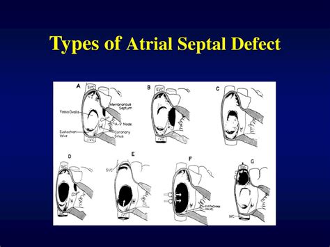 PPT - Atrial Septal Defect PowerPoint Presentation - ID:354587