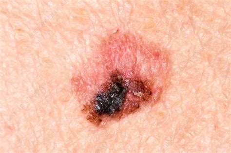 Malignant melanoma - Stock Image - C038/1679 - Science Photo Library