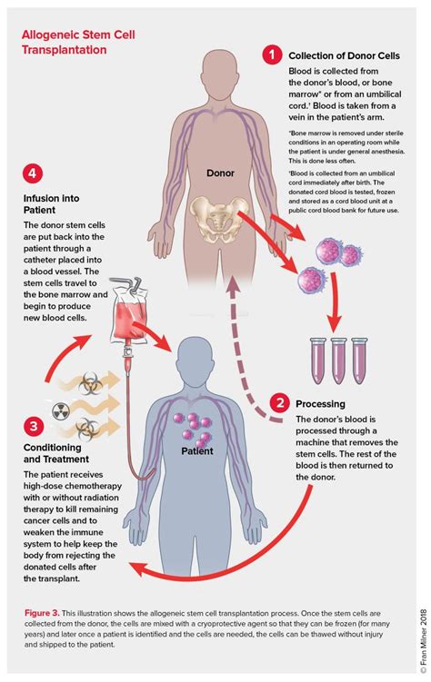 Allogeneic Stem Cell Transplantation | Leukemia and Lymphoma Society