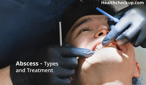 Abscess - Types and Treatment