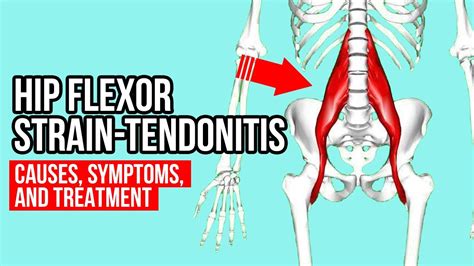 Hip Flexor Strain Treatment