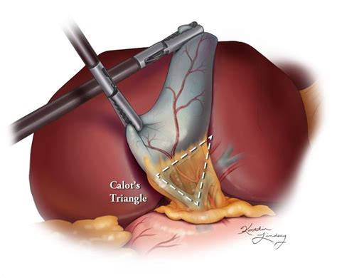 Calot's Triangle. | Med School Pins | Pinterest