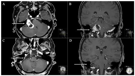 Jugular Foramen Mri