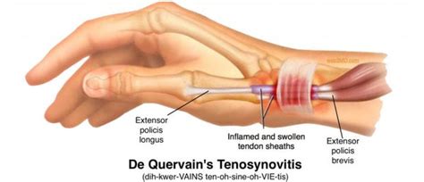 De Quervain’s Tenosynovitis Symptoms, Diagnosis and Treatment - Tynor ...