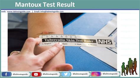 Tuberculosis Skin Test (PPD) Porpuse, Procedure, Results | Lab Tests Guide