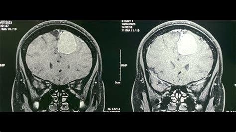 Falcine Meningioma | Brain tumor Surgery | Dr Anuj Bhide | Dr Ajit ...