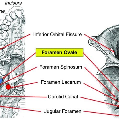 1 Anatomic landmarks for foramen ovale cannulation. Entry point (green ...