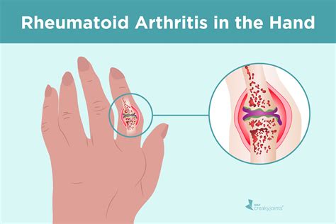 Rheumatoid Arthritis in the Hands: Symptoms and Treatments