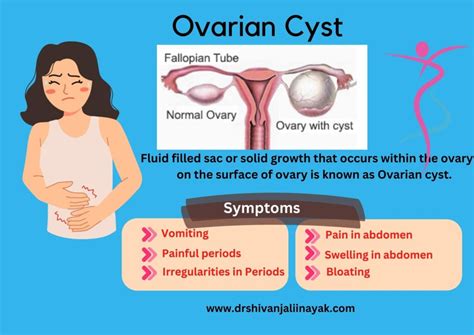 What is Ovarian Cyst and what are its symptoms and treatments? Dr ...