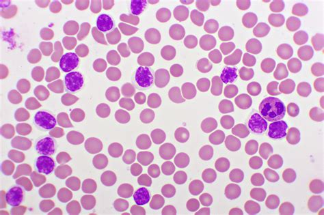 Intro to Chronic Lymphocytic Leukemia (CLL)