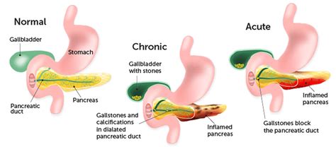 Pediatric pancreatitis causes, symptoms, diagnosis, treatment & prognosis