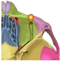 Infraorbital canal - e-Anatomy - IMAIOS