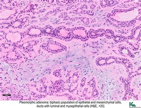 Pleomorphic adenoma