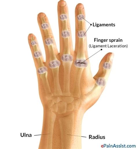 엄지 중수-수지 관절 탈구 및 인대 손상(1st MCP joint dislocation vand ligament injury ...