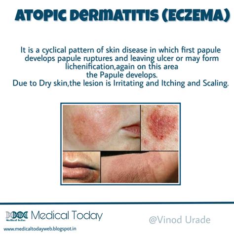 Eczema And Atopic Dermatitis Rashes Causes Symptoms