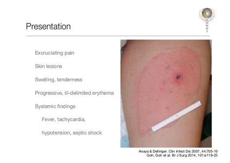 Necrotizing fasciitis