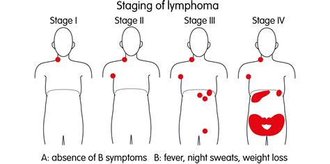 Childhood Hodgkin Lymphoma Disease – Stages and Prognosis