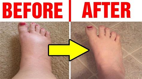 swollen feet after delivery remedy - Maxwell Braswell