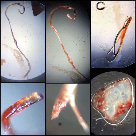 Parasites Under Human Skin