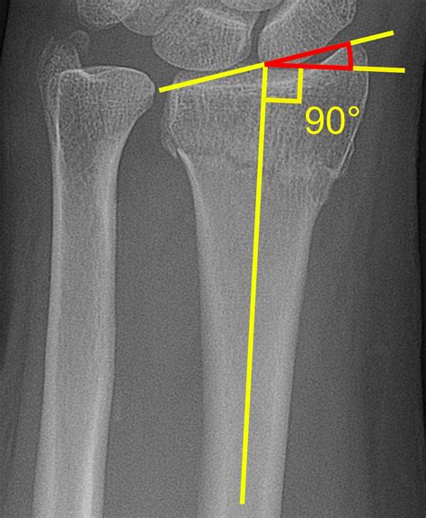 Distal Radius Fracture Angles