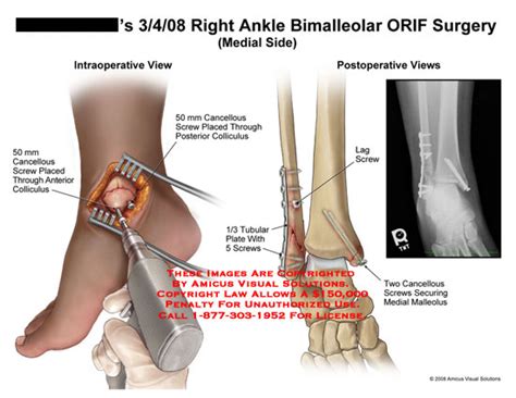 Right Ankle Bimalleolar ORIF Surgery (medial side)