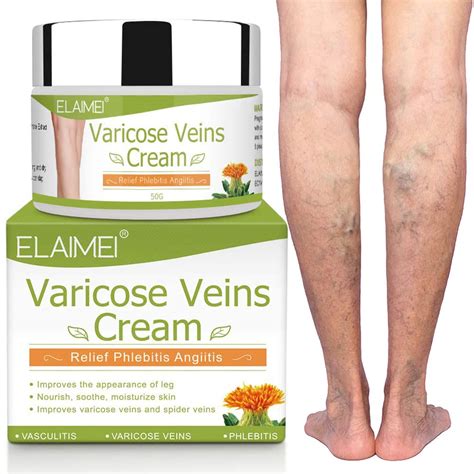 Varicose Vein Cream | Soothing Leg Treatment for Phlebitis & Spider Veins