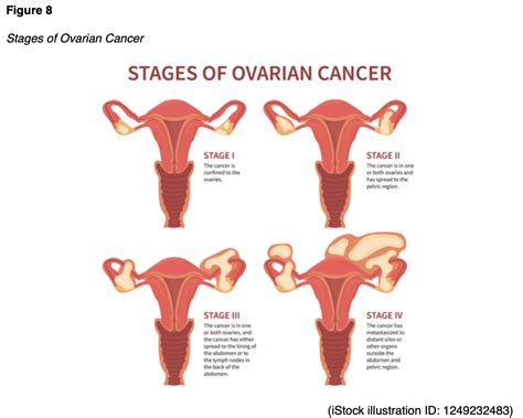 Ovarian Cancer Stages