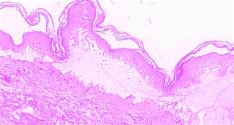 Biopsy of lesion taken on initial presentation demonstrating lichenoid ...