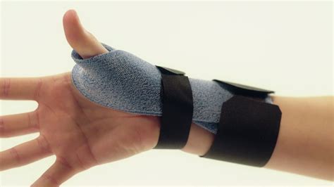 Orthosis for De Quervain’s Tenosynovitis - Orficast Instructional Movie ...