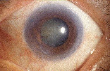 Inferior Corneal Decompensation Following Laser Peripheral Iridotomy in ...