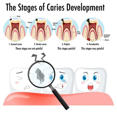 Infographic Of Human In The Stages Of Caries Development Dental Facts ...