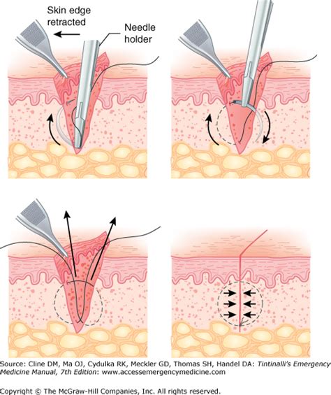 Suture Help | Student Doctor Network