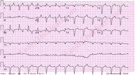 Right Axis Deviation ECG Example 1 | LearntheHeart.com