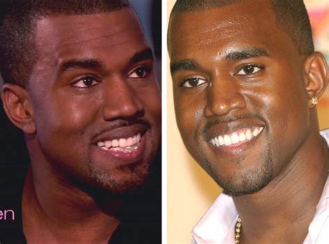 Kanye West Teeth Before And After Photos; Kanye West Replaces His ...