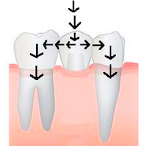 Dental Bridge - Procedure, Dental Bridge Vs Dental Implant