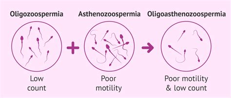 What is oligoasthenozoospermia? - Causes and treatments