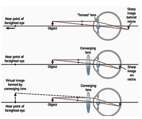 Why Is the Near Point Closer for a Myopic Person