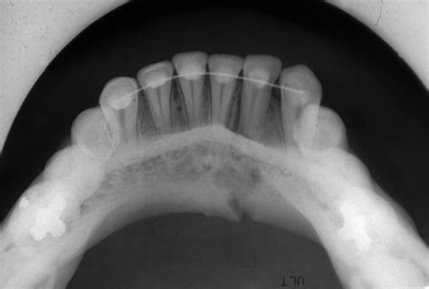 Mandibular Fractures