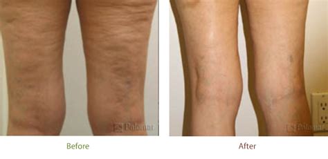 Laser Skin Tightening Before and After | El Dorado Hills