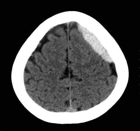 Acute Subdural Hematoma - JETem