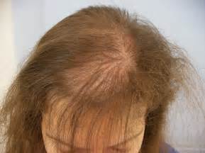 Female Baldness: treatments and remedies - Medicap