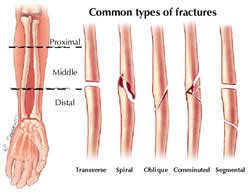 Difference between Fracture and Break | Fracture vs Break