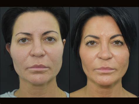 Patient 122206134 | Profound RF Skin Tightening Before & After Photos ...