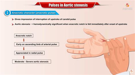 PULSES IN AORTIC STENOSIS - #Usmle Cardiology - YouTube