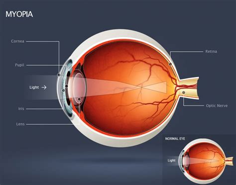 Progressive (High) Myopia - American Association for Pediatric ...